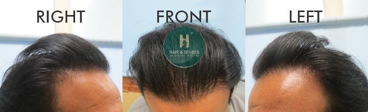 Hair Growth after 8 Months